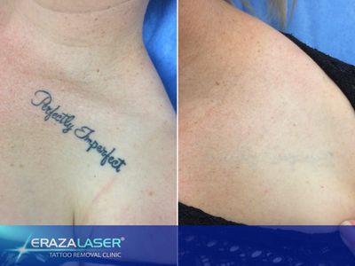 tattoo-removal-clinic-4