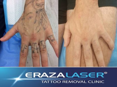 tattoo-removal-clinic-3