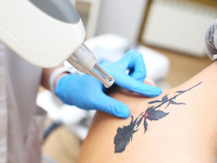 laser-tattoo-removal-clinic-offers-invited-0