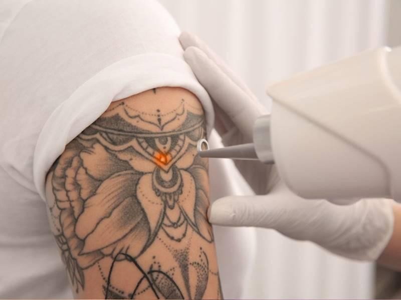 Tattoo Removal - Dr Nathan Holt