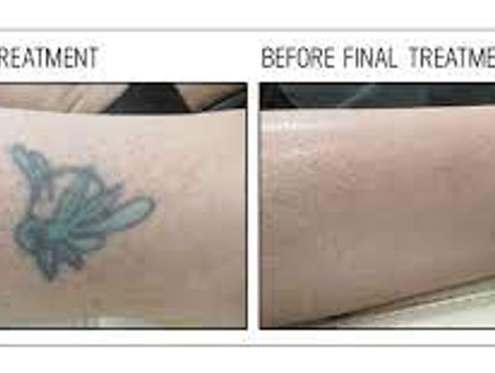 tattoo-removing-clinic-glj2312-3