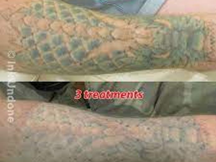 tattoo-removing-clinic-glj2312-2