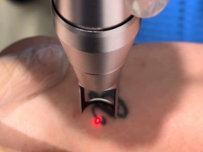 cosmetic-injectables-and-advanced-aesthetics-clinic-taree-nsw-8