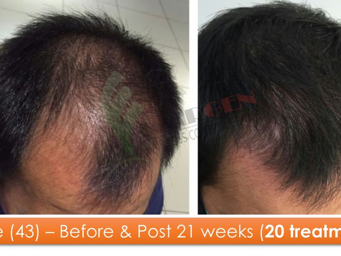 exciting-business-opportunity-in-the-hair-loss-treatment-industry-sydney-nsw-2
