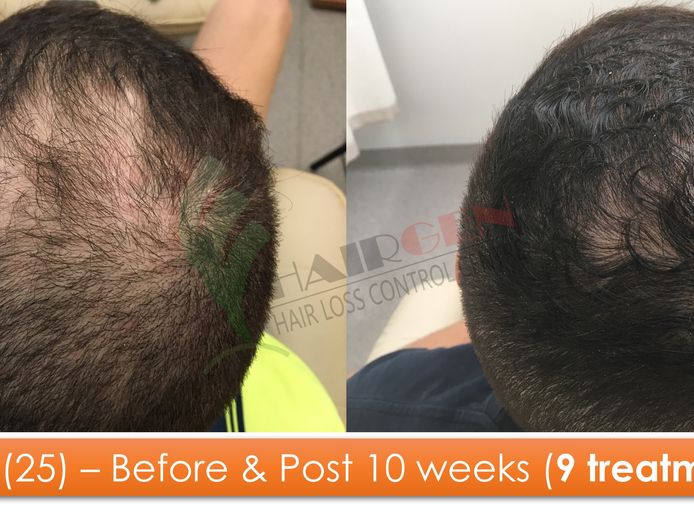 exciting-business-opportunity-in-the-hair-loss-treatment-industry-sydney-nsw-9