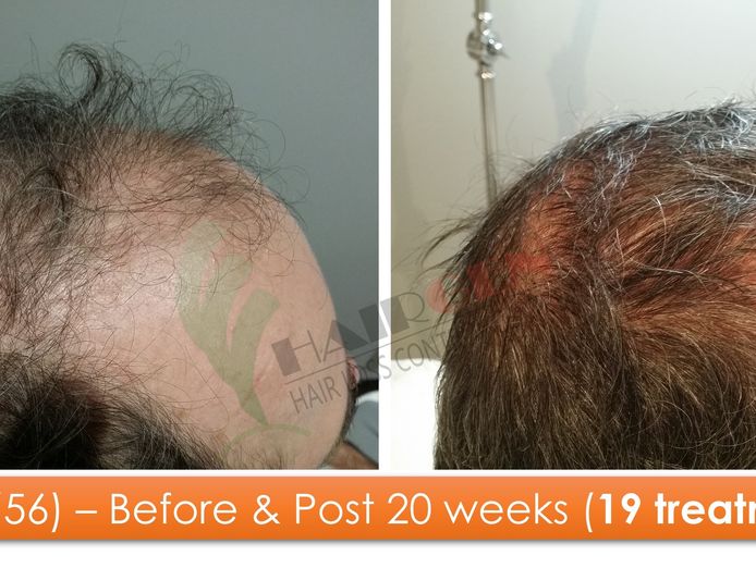 exciting-business-opportunity-in-the-hair-loss-treatment-industry-sydney-nsw-1