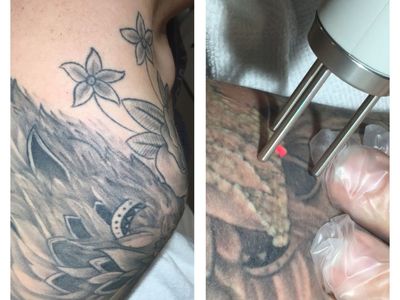 premium-tattoo-removal-amp-skin-rejuvenation-clinic-in-lane-cove-nsw-2