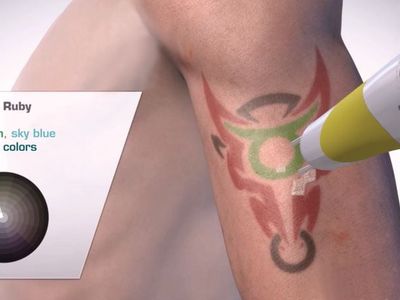 premium-tattoo-removal-amp-skin-rejuvenation-clinic-in-lane-cove-nsw-4