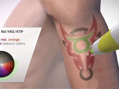 premium-tattoo-removal-amp-skin-rejuvenation-clinic-in-lane-cove-nsw-5
