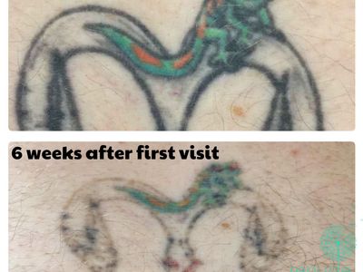 premium-tattoo-removal-amp-skin-rejuvenation-laser-7