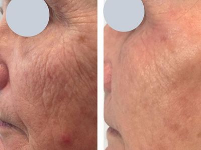 premium-tattoo-removal-amp-skin-rejuvenation-clinic-in-lane-cove-nsw-3