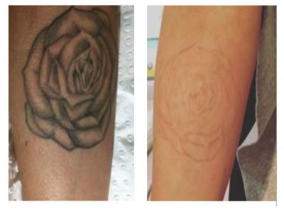 premium-tattoo-removal-amp-skin-rejuvenation-clinic-in-lane-cove-nsw-0