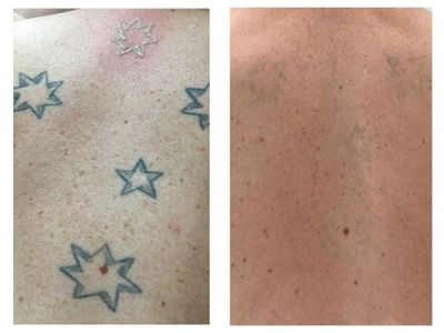premium-tattoo-removal-amp-skin-rejuvenation-clinic-in-lane-cove-nsw-8