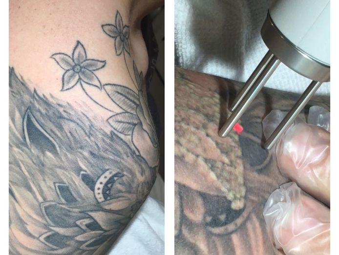 premium-tattoo-removal-amp-skin-rejuvenation-laser-2