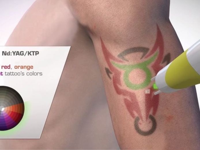 premium-tattoo-removal-amp-skin-rejuvenation-clinic-in-lane-cove-nsw-5