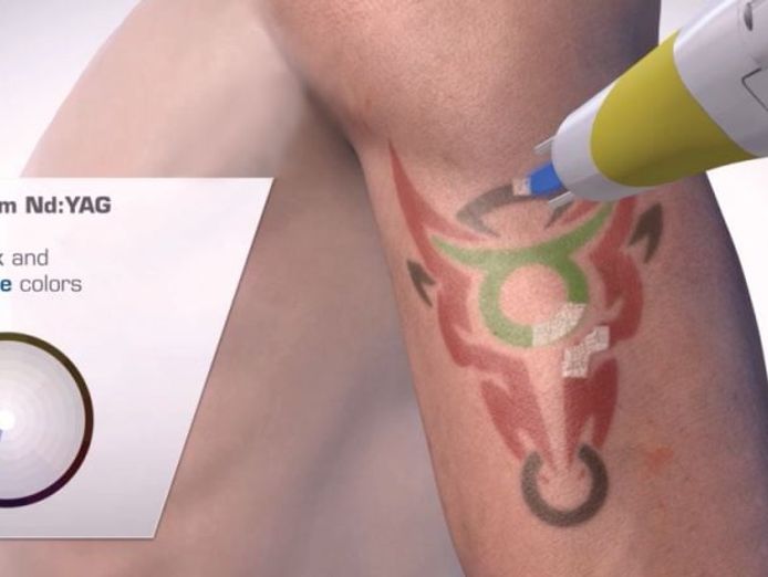 premium-tattoo-removal-amp-skin-rejuvenation-clinic-in-lane-cove-nsw-6