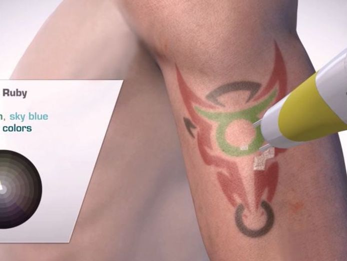 premium-tattoo-removal-amp-skin-rejuvenation-clinic-in-lane-cove-nsw-4