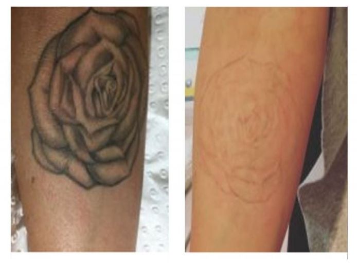 premium-tattoo-removal-amp-skin-rejuvenation-clinic-in-lane-cove-nsw-0