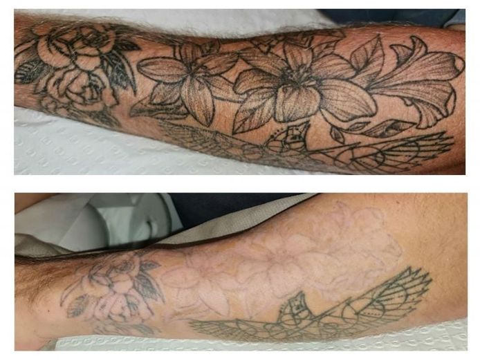 premium-tattoo-removal-amp-skin-rejuvenation-clinic-in-lane-cove-nsw-1