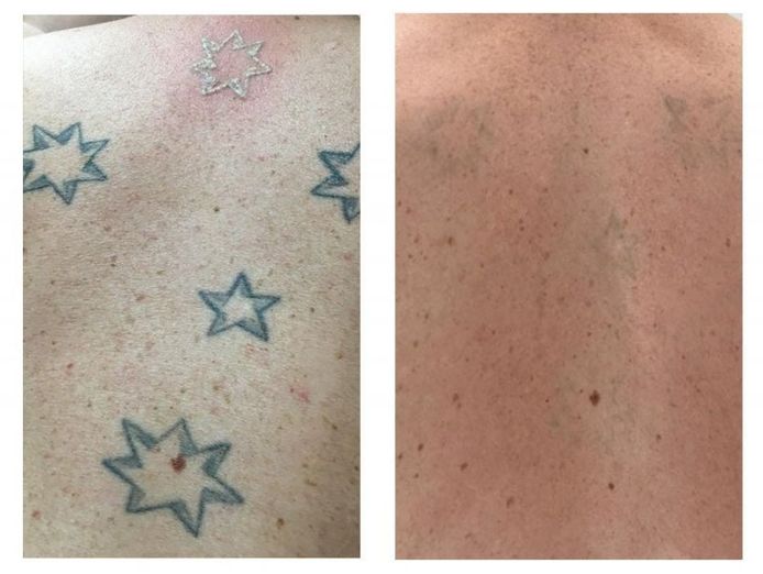 premium-tattoo-removal-amp-skin-rejuvenation-clinic-in-lane-cove-nsw-8