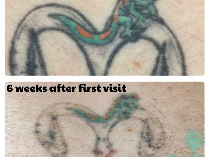 premium-tattoo-removal-amp-skin-rejuvenation-clinic-in-lane-cove-nsw-7